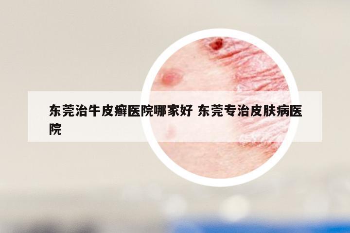 东莞治牛皮癣医院哪家好 东莞专治皮肤病医院