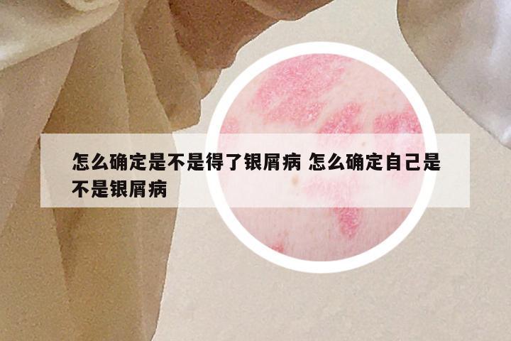 怎么确定是不是得了银屑病 怎么确定自己是不是银屑病