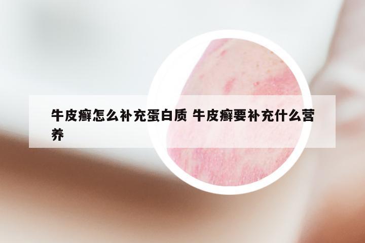 牛皮癣怎么补充蛋白质 牛皮癣要补充什么营养