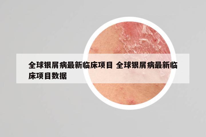 全球银屑病最新临床项目 全球银屑病最新临床项目数据