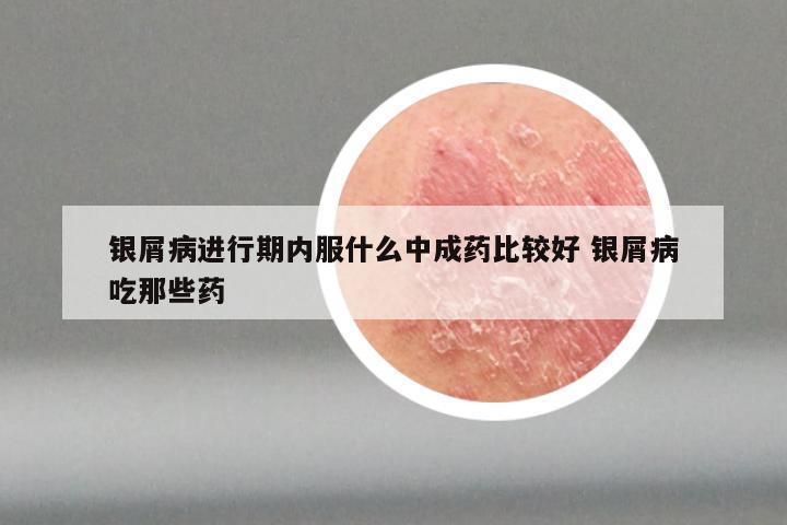 银屑病进行期内服什么中成药比较好 银屑病吃那些药