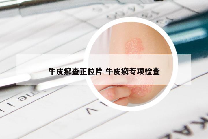 牛皮癣查正位片 牛皮癣专项检查