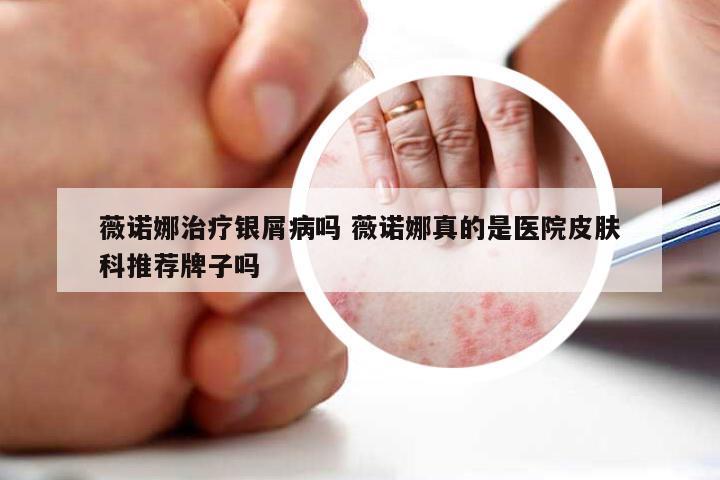 薇诺娜治疗银屑病吗 薇诺娜真的是医院皮肤科推荐牌子吗