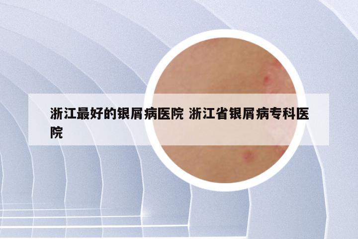 浙江最好的银屑病医院 浙江省银屑病专科医院