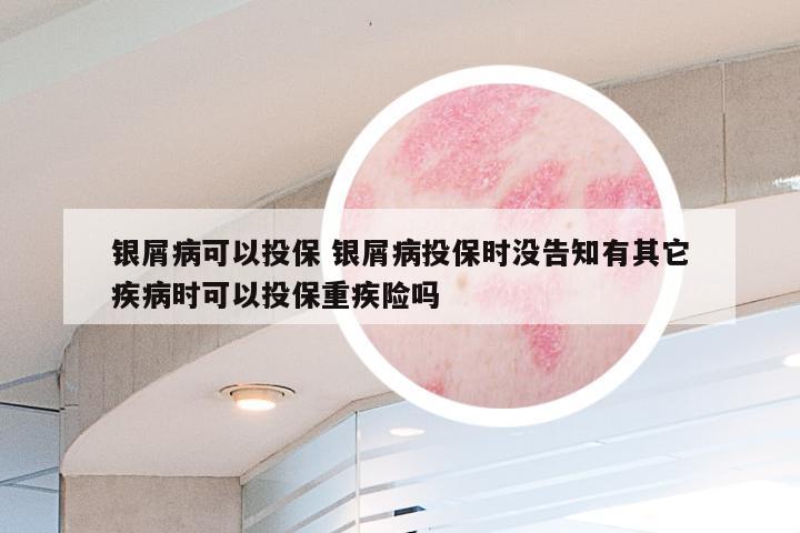 银屑病可以投保 银屑病投保时没告知有其它疾病时可以投保重疾险吗