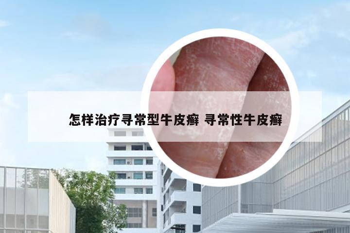 怎样治疗寻常型牛皮癣 寻常性牛皮癣
