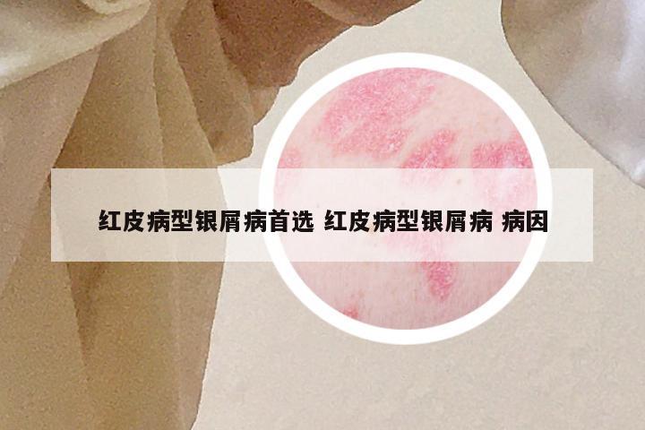 红皮病型银屑病首选 红皮病型银屑病 病因