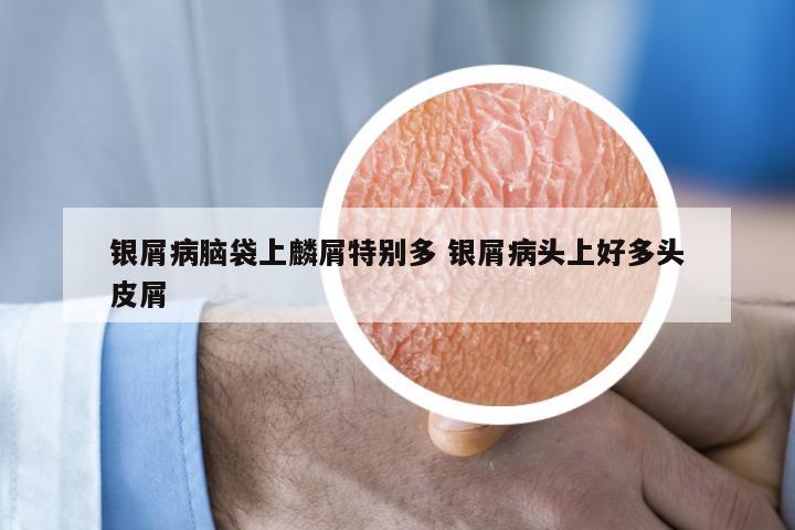 银屑病脑袋上麟屑特别多 银屑病头上好多头皮屑