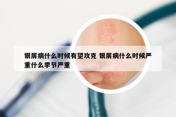 银屑病什么时候有望攻克 银屑病什么时候严重什么季节严重