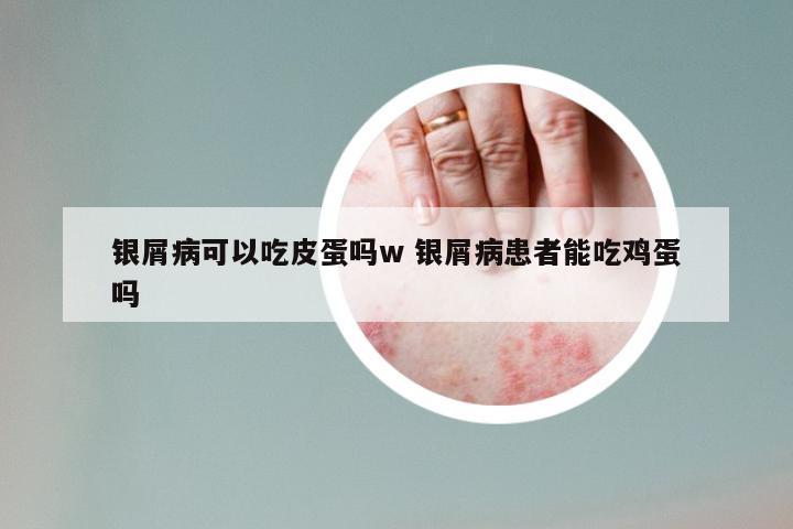 银屑病可以吃皮蛋吗w 银屑病患者能吃鸡蛋吗