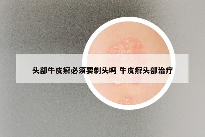 头部牛皮癣必须要剃头吗 牛皮癣头部治疗