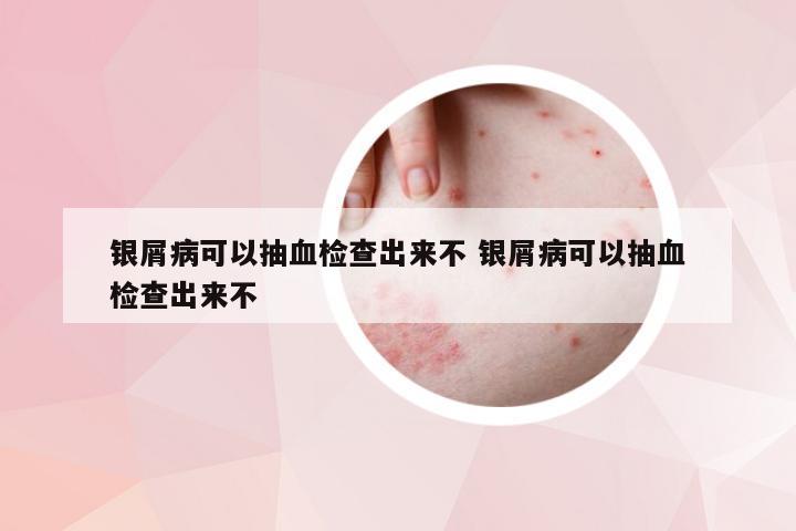 银屑病可以抽血检查出来不 银屑病可以抽血检查出来不