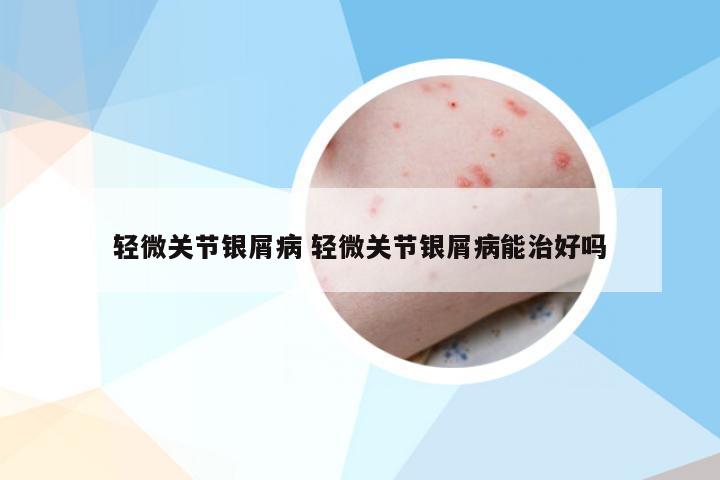 轻微关节银屑病 轻微关节银屑病能治好吗