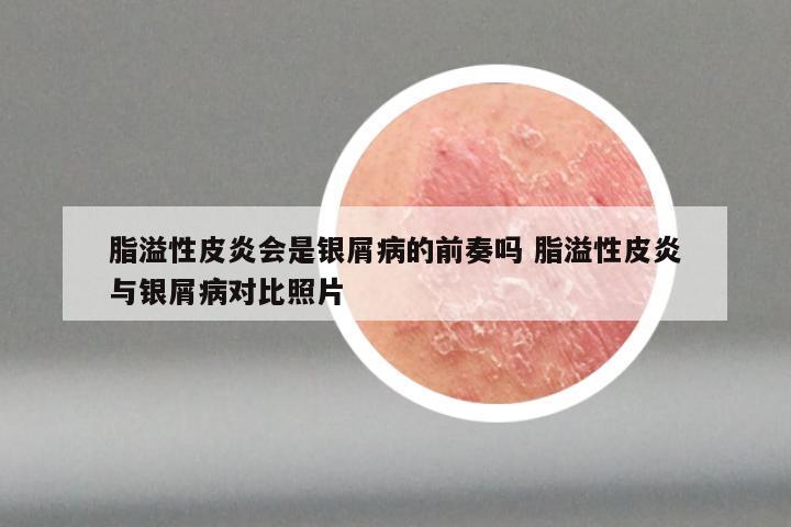 脂溢性皮炎会是银屑病的前奏吗 脂溢性皮炎与银屑病对比照片