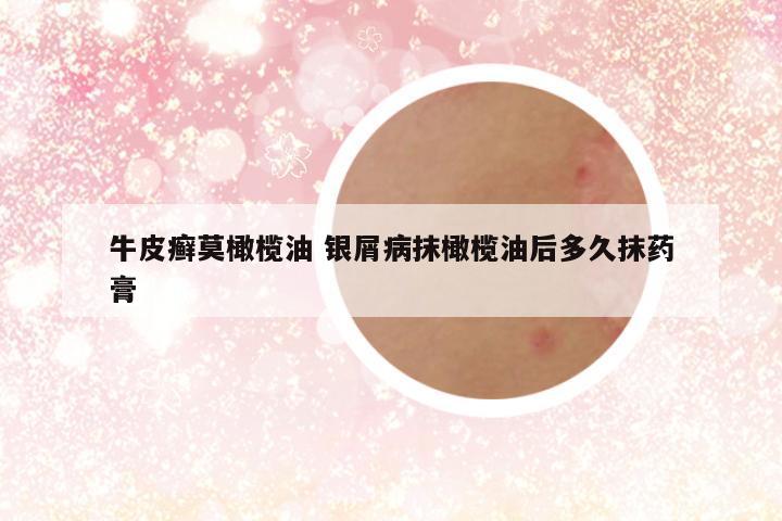 牛皮癣莫橄榄油 银屑病抹橄榄油后多久抹药膏