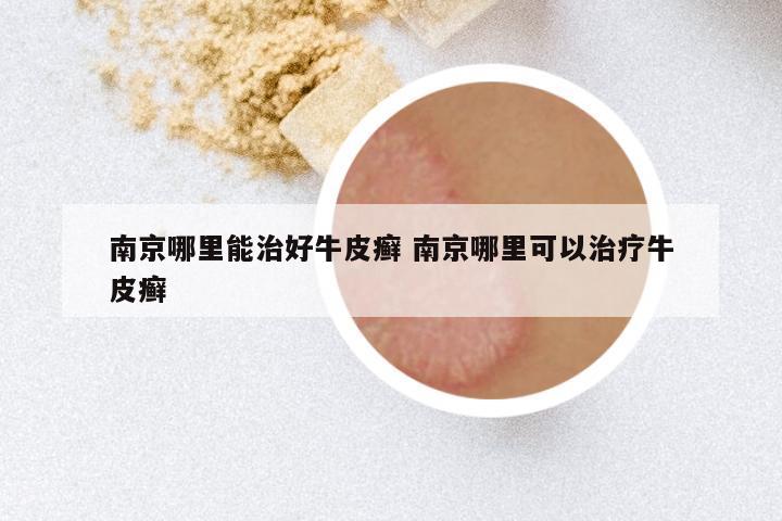 南京哪里能治好牛皮癣 南京哪里可以治疗牛皮癣