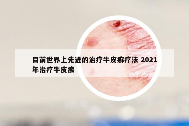 目前世界上先进的治疗牛皮癣疗法 2021年治疗牛皮癣