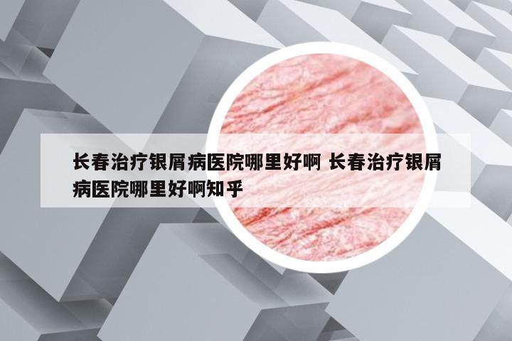 长春治疗银屑病医院哪里好啊 长春治疗银屑病医院哪里好啊知乎
