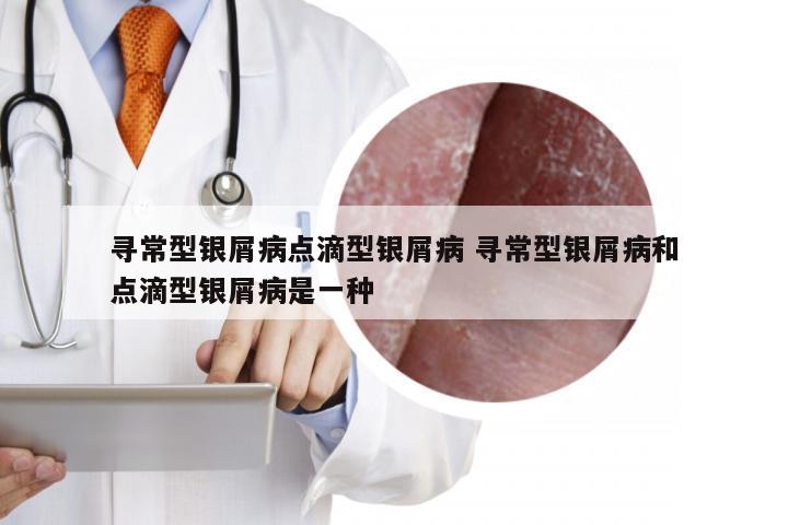 寻常型银屑病点滴型银屑病 寻常型银屑病和点滴型银屑病是一种