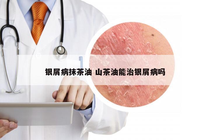 银屑病抹茶油 山茶油能治银屑病吗