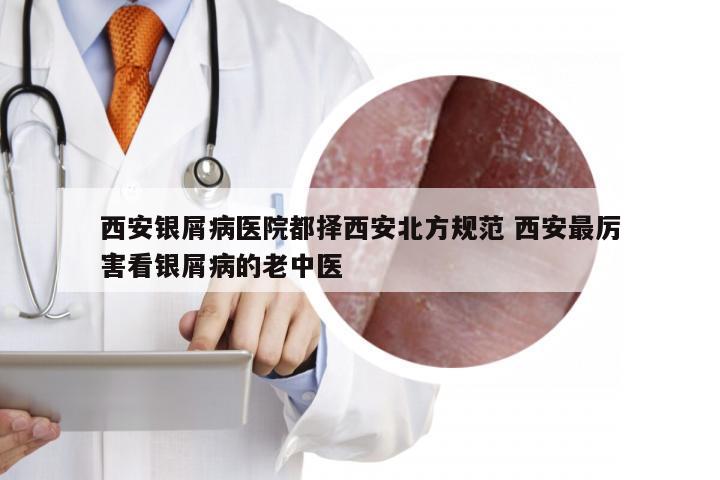 西安银屑病医院都择西安北方规范 西安最厉害看银屑病的老中医