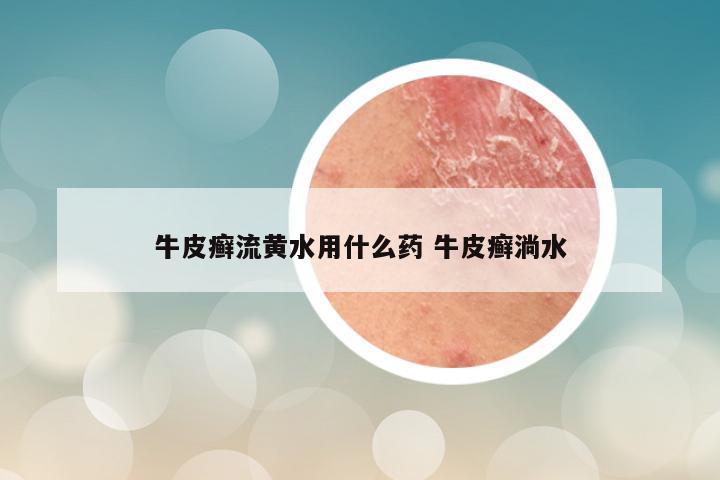 牛皮癣流黄水用什么药 牛皮癣淌水