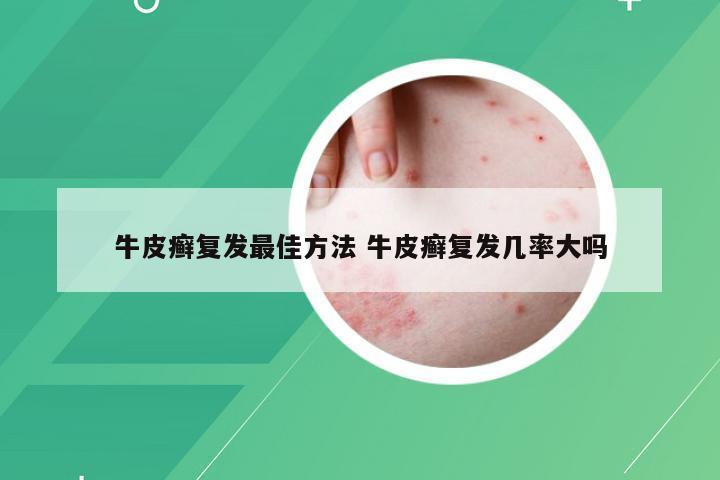 牛皮癣复发最佳方法 牛皮癣复发几率大吗