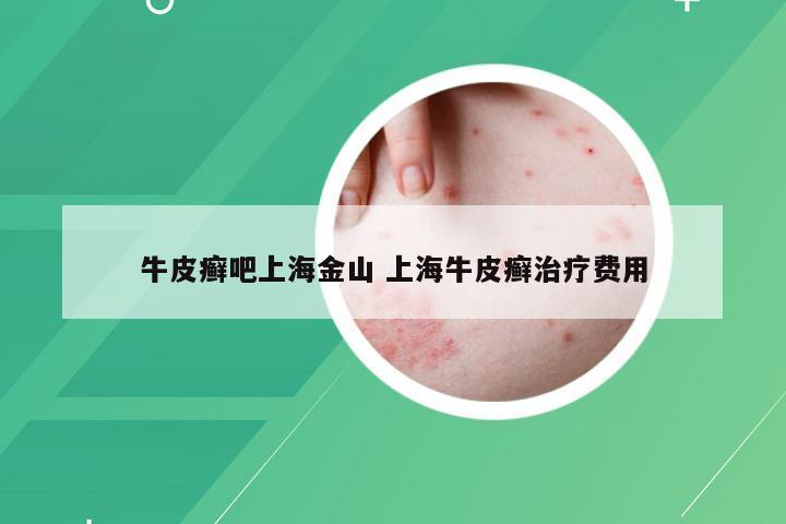 牛皮癣吧上海金山 上海牛皮癣治疗费用