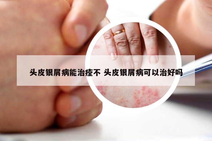 头皮银屑病能治痊不 头皮银屑病可以治好吗