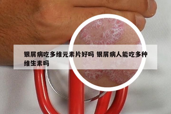 银屑病吃多维元素片好吗 银屑病人能吃多种维生素吗