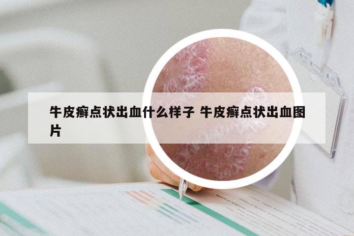 牛皮癣点状出血什么样子 牛皮癣点状出血图片