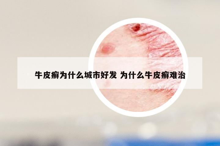牛皮癣为什么城市好发 为什么牛皮癣难治