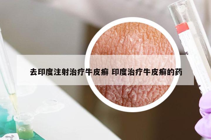 去印度注射治疗牛皮癣 印度治疗牛皮癣的药