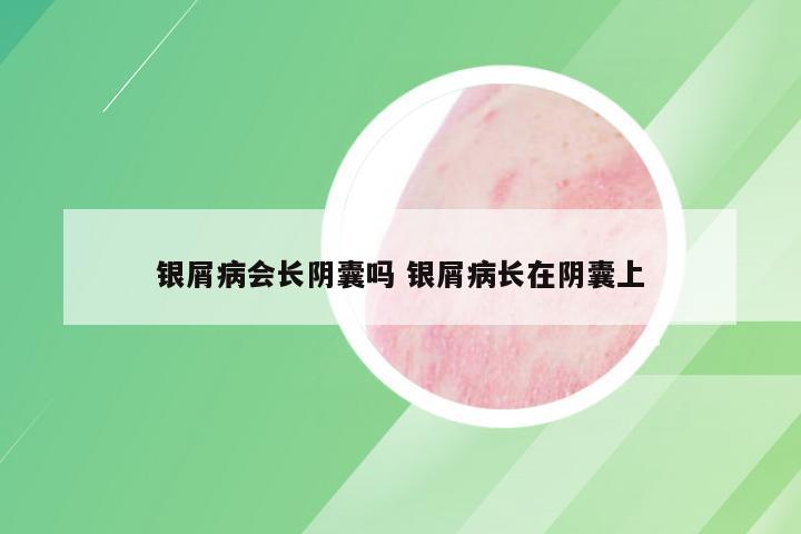 银屑病会长阴囊吗 银屑病长在阴囊上