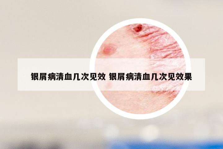 银屑病清血几次见效 银屑病清血几次见效果