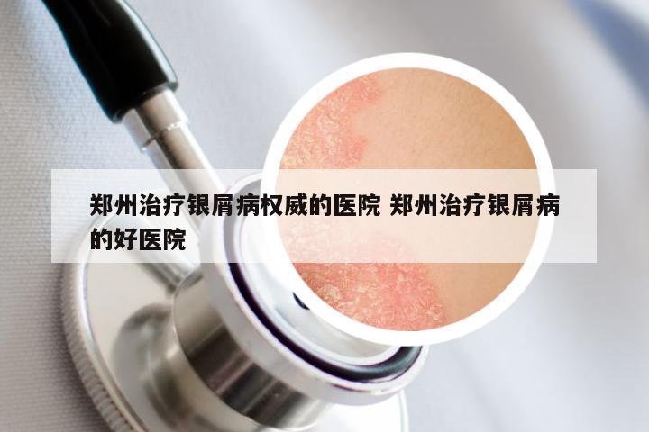 郑州治疗银屑病权威的医院 郑州治疗银屑病的好医院