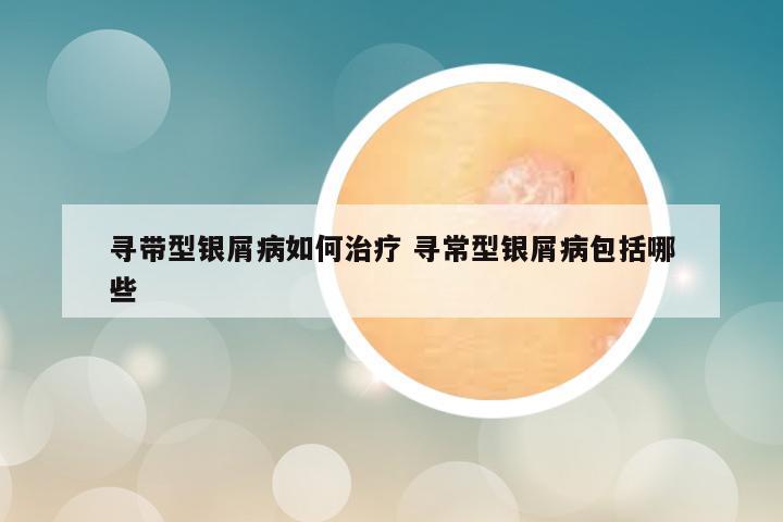寻带型银屑病如何治疗 寻常型银屑病包括哪些