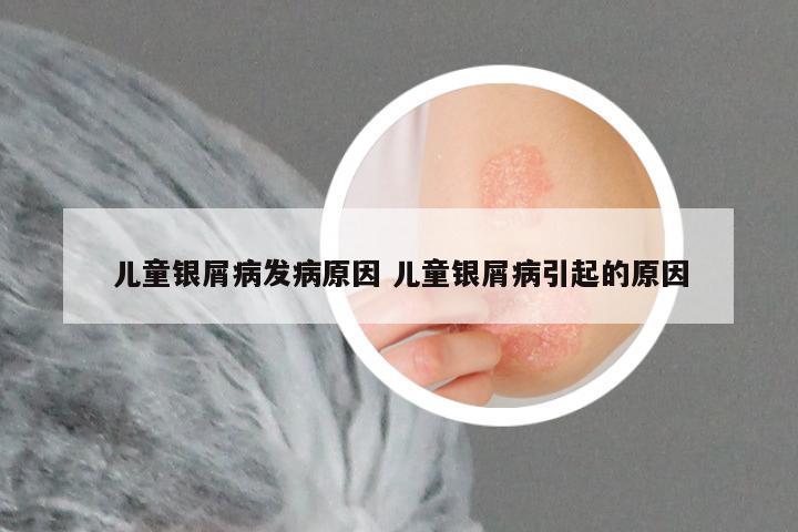 儿童银屑病发病原因 儿童银屑病引起的原因