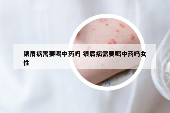 银屑病需要喝中药吗 银屑病需要喝中药吗女性