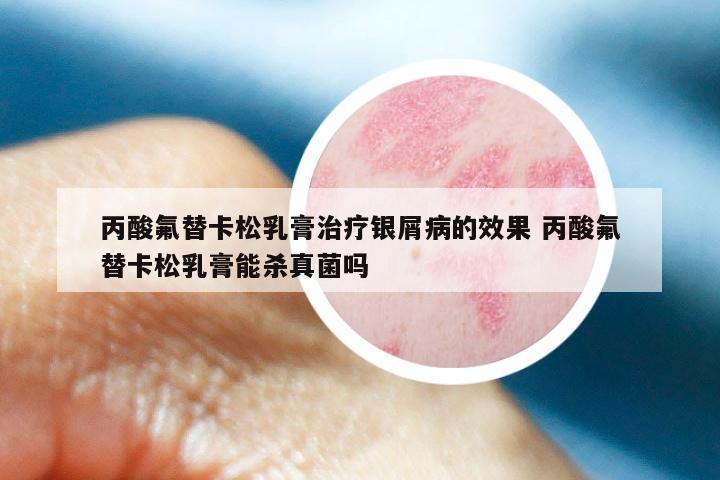 丙酸氟替卡松乳膏治疗银屑病的效果 丙酸氟替卡松乳膏能杀真菌吗