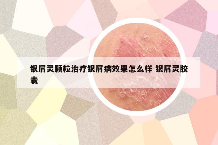 银屑灵颗粒治疗银屑病效果怎么样 银屑灵胶囊