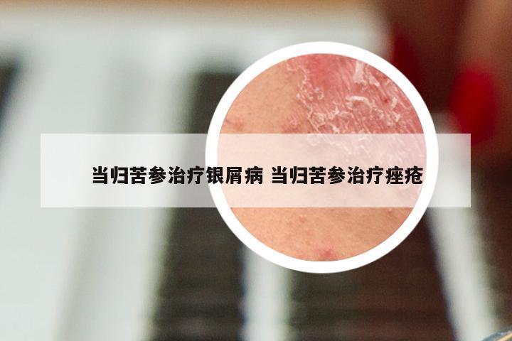 当归苦参治疗银屑病 当归苦参治疗痤疮