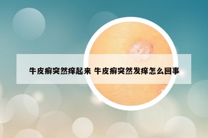 牛皮癣突然痒起来 牛皮癣突然发痒怎么回事