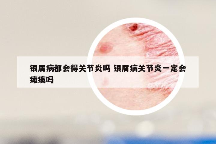银屑病都会得关节炎吗 银屑病关节炎一定会瘫痪吗