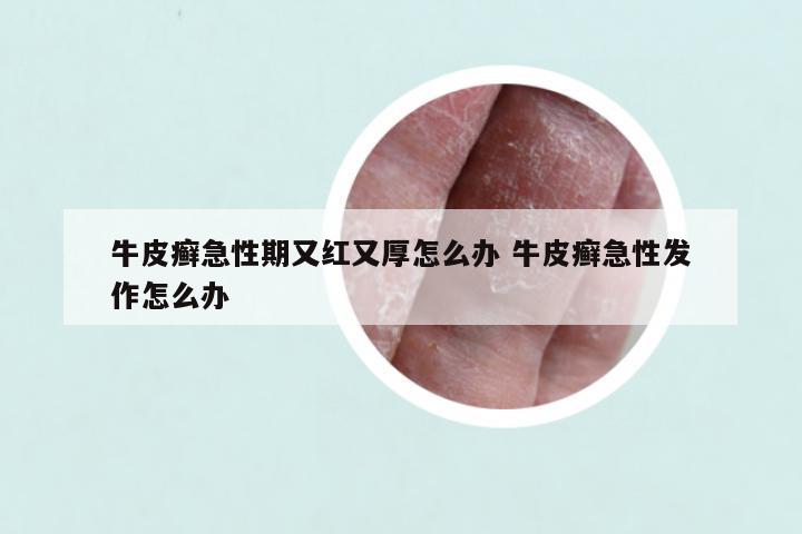 牛皮癣急性期又红又厚怎么办 牛皮癣急性发作怎么办