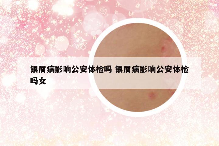 银屑病影响公安体检吗 银屑病影响公安体检吗女
