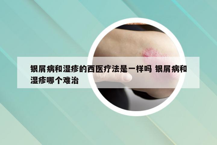 银屑病和湿疹的西医疗法是一样吗 银屑病和湿疹哪个难治