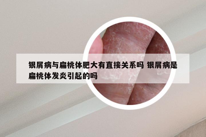 银屑病与扁桃体肥大有直接关系吗 银屑病是扁桃体发炎引起的吗