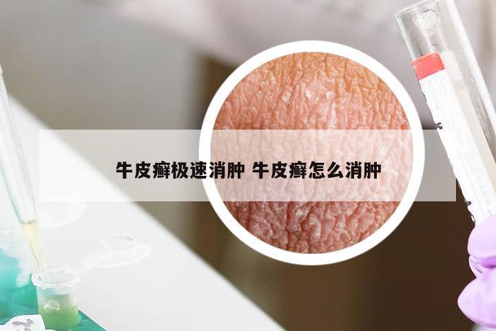 牛皮癣极速消肿 牛皮癣怎么消肿