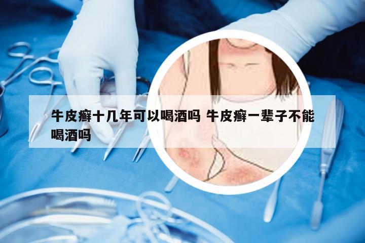 牛皮癣十几年可以喝酒吗 牛皮癣一辈子不能喝酒吗